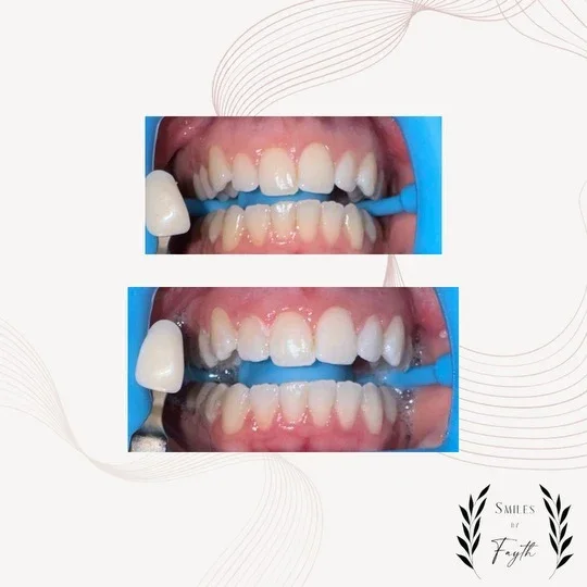 Before and after Full Whitening results