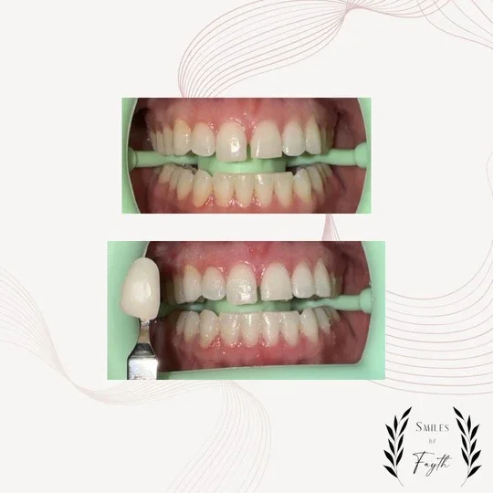 Before and after whitening results, second client